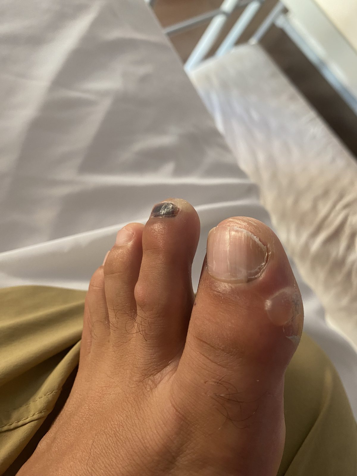 A bruised, blackened toenail on a bare foot